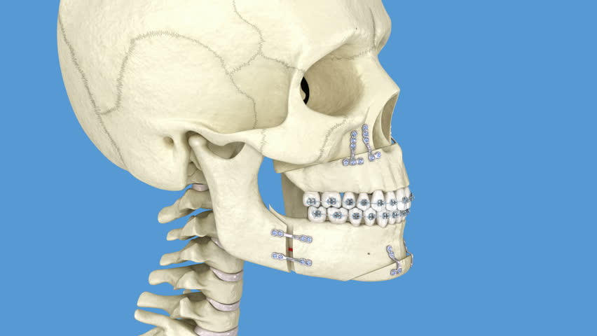Mandibular Advancement surgery. 3D Animation
