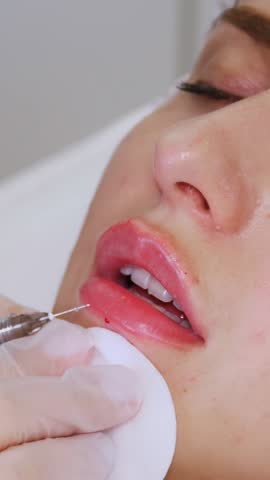 Close-up, female face. Surgeon, in medical gloves, pierces womans lip with a syringe and slowly injects hyaluronic acid. lip augmentation procedure. beauty injections. Plastic surgery.