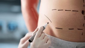 Man Aesthetic Plastic Surgery In Hospital. Tummy Abdomen Marks - Powered by Shutterstock - Get 15% off with code: PIKWIZARD15
