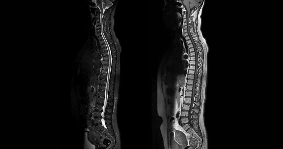 MRI Screening whole spine  sagittal view showing  spine compress spinal cord ( Myelopathy ).