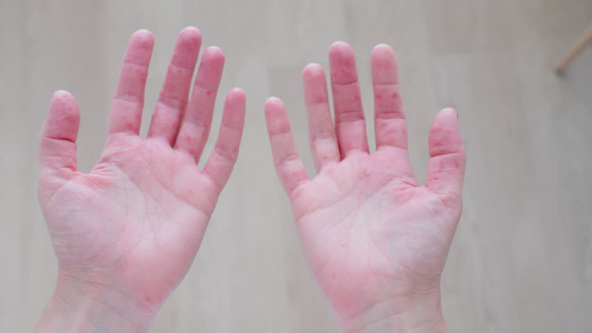 Understanding hand rashes and their causes such as eczema and chickenpox