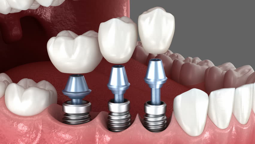 Tooth crowns placement on 3 implants. Dental 3D animation