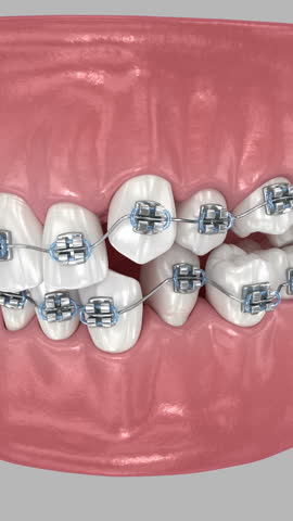 Abnormal teeth position and correction with braces. Dental 3D animation
