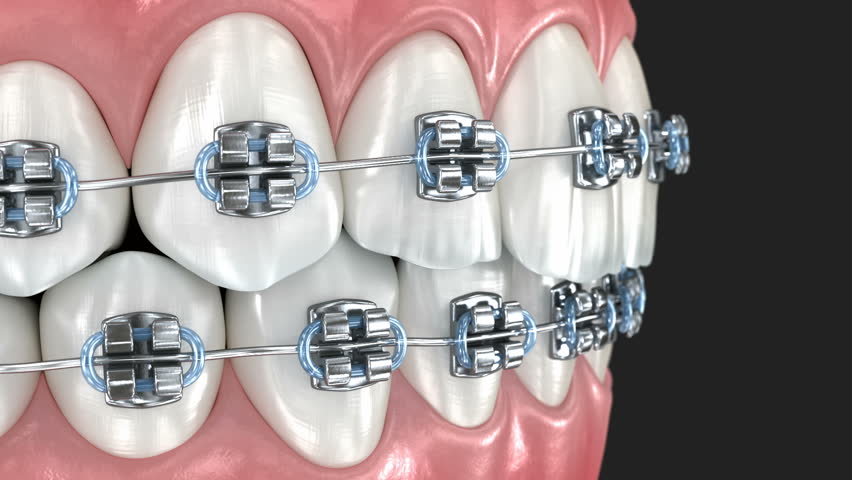 Metal braces on teeth, macro view. 3D illustration