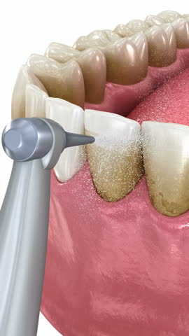 Oral hygiene: Air flow teeth cleaning process. Dental 3D animation