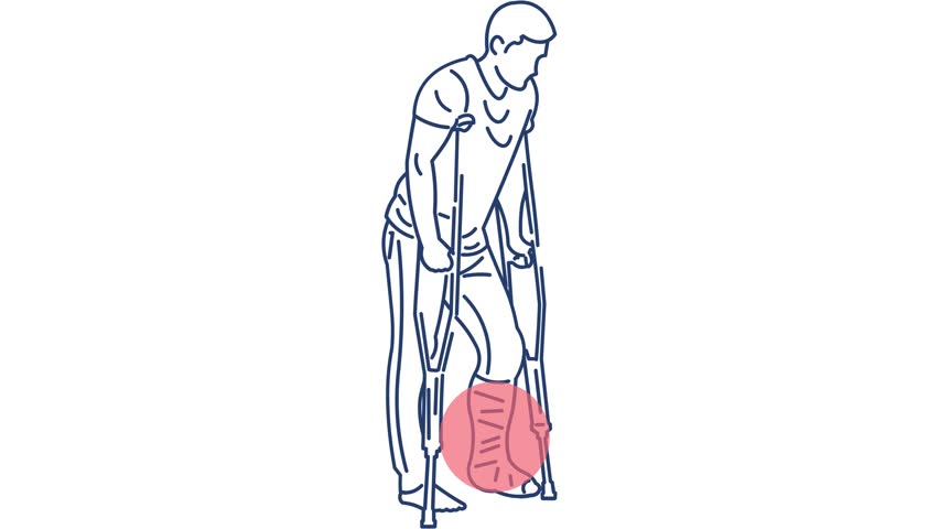 Vector illustration of man with broken leg using crutches and cast