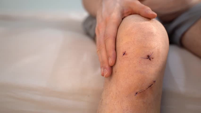 Male knee with wound, post-surgical stitches from ACL reconstruction, hand gently touched in calming motion. Concept of emotional, mindful healing and body positivity during physical recovery process