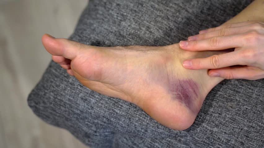 Ankle with deep purple bruise is gently massaged by man hand, shown on soft textured surface. Concept of mindful recovery, managing swelling and pain at home with consistent non-invasive self-care