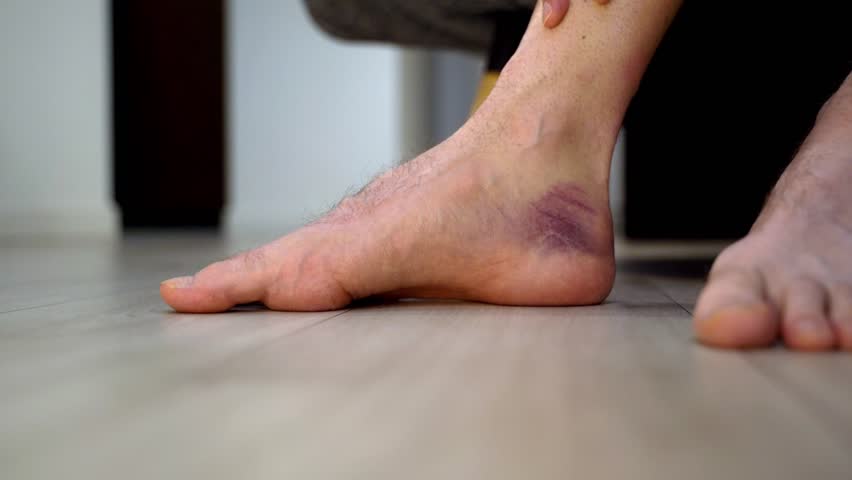 Male foot with deep purple bruise rests on wooden floor in calm environment, showing discoloration and inflammation. Concept of passive recovery, hand monitoring after ankle injury or sprain. Close-up