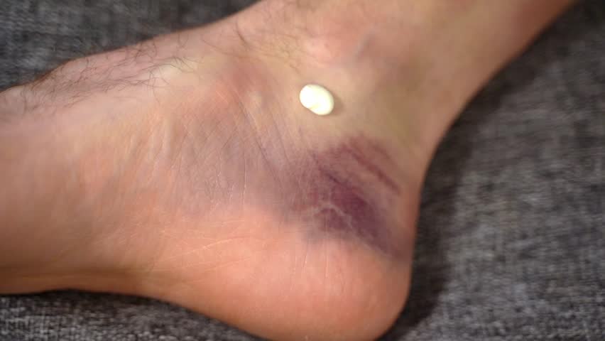 Male fingers massage, apply medical balm into purple bruise on swelling foot. Concept of topical cream application to reduce inflammation, restore skin texture and aid bruising recovery process