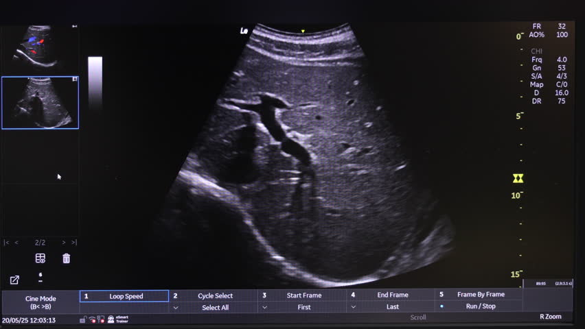 Ultrasound Scan Display on Medical Monitor, Detailed Internal Organ Imaging Scene