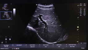 Ultrasound Scan Display on Medical Monitor, Detailed Internal Organ Imaging Scene - Powered by Shutterstock - Get 15% off with code: PIKWIZARD15