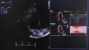Cardiac Ultrasound Display with ECG, Medical Imaging and Heart Strain Analysis - Powered by Shutterstock - Get 15% off with code: PIKWIZARD15