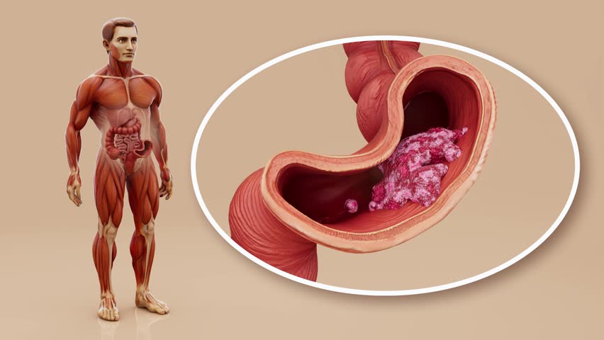 Conceptual animation of a man's anatomy and colon cancer