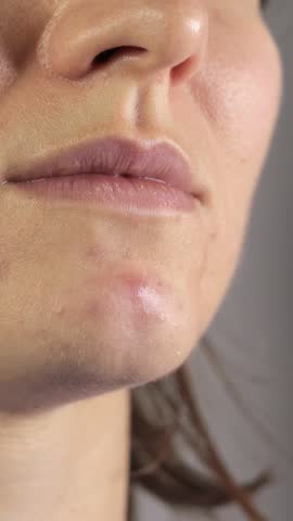 Vertical video of woman applying patches to treat acne on her face. Close up, 4k footage.