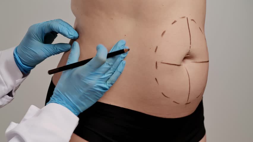 A medical professional in gloves marks lines on a patient's abdomen, indicating preparation for cosmetic surgery. Concept of plastic surgery, medical evaluation procedures and health. Slow motion