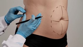 A medical professional in gloves marks lines on a patient's abdomen, indicating preparation for cosmetic surgery. Concept of plastic surgery, medical evaluation procedures and health. Slow motion - Powered by Shutterstock - Get 15% off with code: PIKWIZARD15