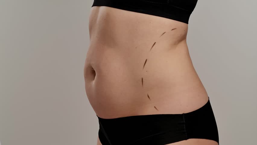 A medical professional in gloves marks lines on a patient's abdomen, indicating preparation for cosmetic surgery. Concept of plastic surgery, medical evaluation procedures and health. Slow motion