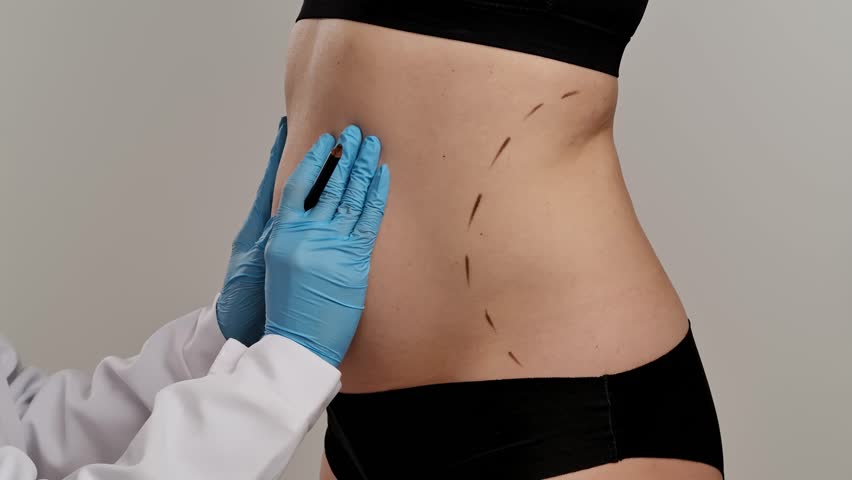 A medical professional in gloves marks lines on a patient's abdomen, indicating preparation for cosmetic surgery. Concept of plastic surgery, medical evaluation procedures and health. Slow motion