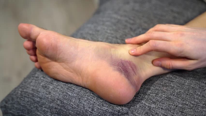 Male hand gently moves over side of foot with large purple bruise, resting on gray couch indoors. Concept of sensory self-relief after minor injury through consistent, soothing physical touch at home