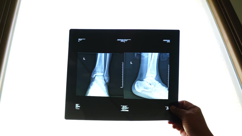 Close-up of hand holding X-ray film showing ankle and foot bones, viewed against bright medical lightbox. Ideal for healthcare, diagnostics, education, or hospital content.