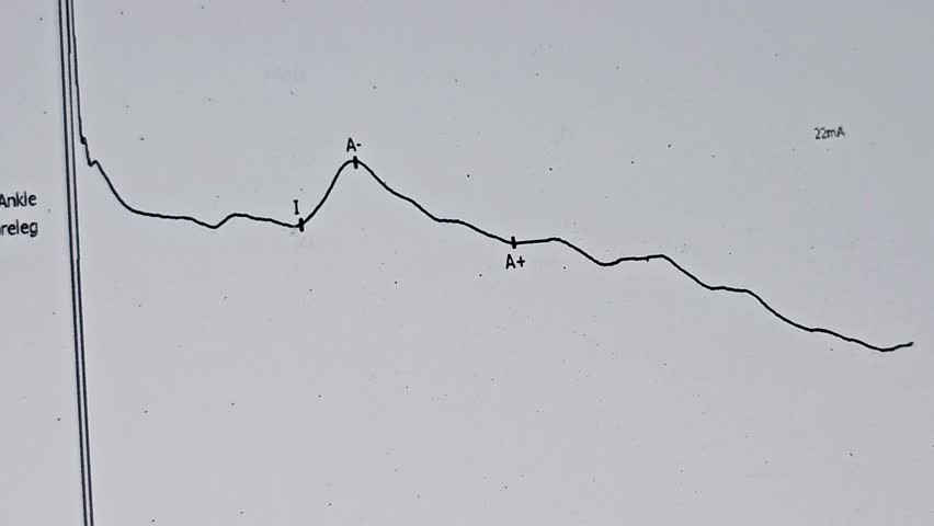 Nerve conduction study Electrophysiological studies for both LL lower limbs motor and sensory nerves shows, no evidence of proximal or distal entrapment and no evidence of peripheral neuropathy