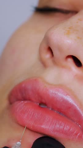 Close-up, female face. Surgeon, in medical gloves, pierces womans lip with a syringe and slowly injects hyaluronic acid. lip augmentation procedure. beauty injections. Plastic surgery.