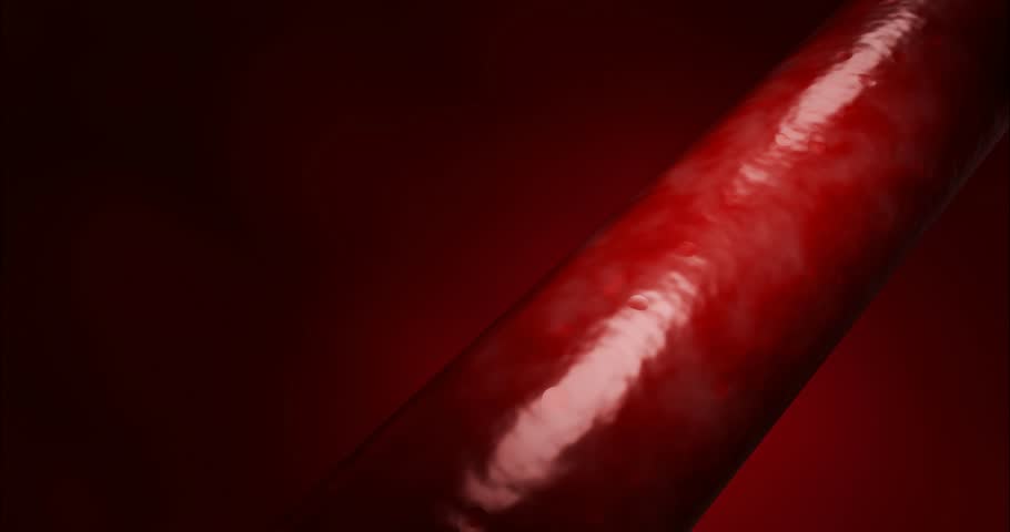 Artery narrowing due to cholesterol deposits, fast food intake, high-sugar beverages, alcohol addiction, processed foods, emphasizing risks hypertension, stroke, cardiovascular death. 3D rendering