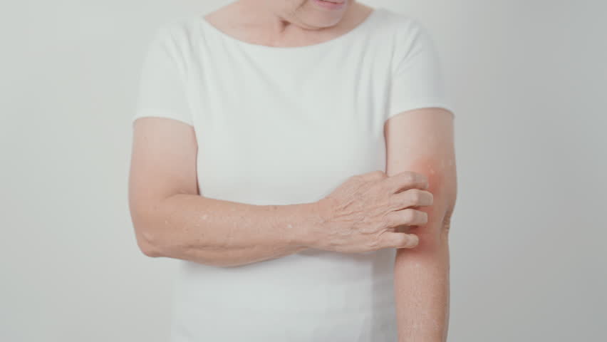 Elderly woman itching arm and body scratching for Skin Allergy from insect bite and food dermatitis. Dermatology, Leprosy day, Systemic lupus erythematosus, Psoriasis, Urticaria and rash Eczema