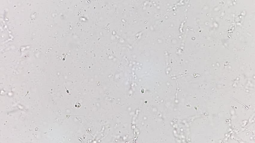 Asthenozoospermia abnormal semen analysis on microscopic examination.