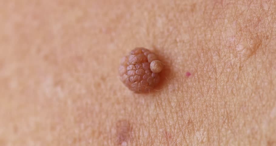 Red mole, growth, wart papilloma, nevus on armpit skin woman, banner medical dermatology.