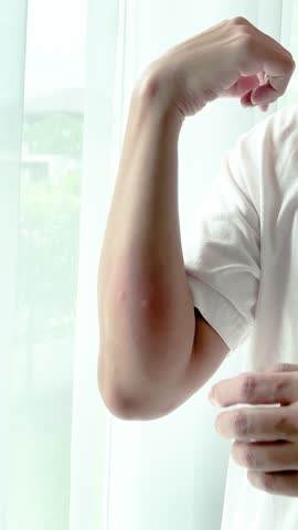 Young asian man itching and scratching on arm from itchy dry skin eczema dermatitis