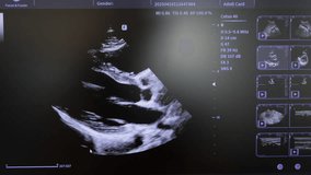 Cardiac Ultrasound Examination Displayed on Screen, Real-Time Diagnostic Imaging with Parameters - Powered by Shutterstock - Get 15% off with code: PIKWIZARD15
