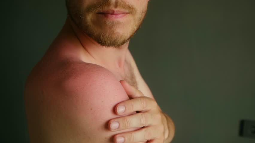 Redness and inflammation appear on man shoulder as he gently touches sunburned skin, highlighting discomfort and sensitivity caused excessive sun exposure. Man touching red sunburned skin on shoulder