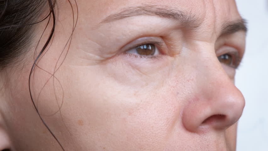 Allergy in puffy eyes. A woman suffers from severe allergies in her eyes.