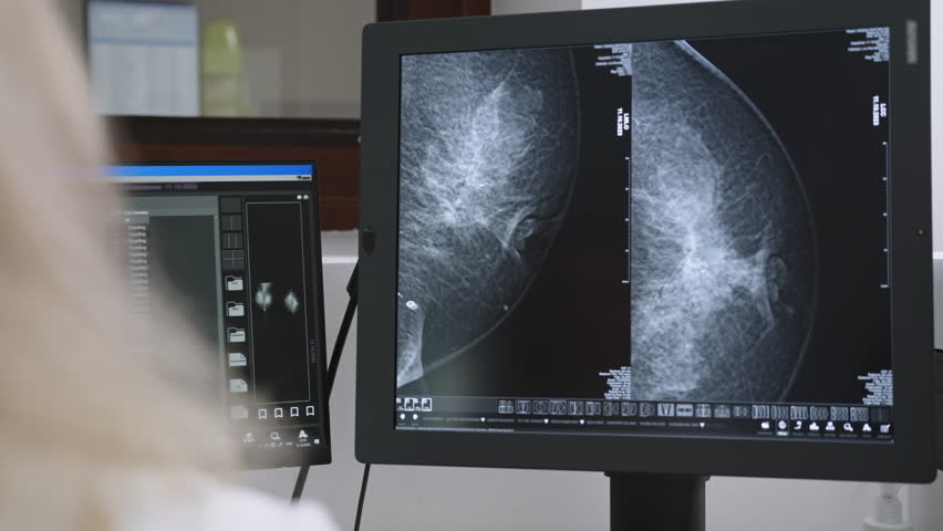 A woman examines a mammogram, highlighting the importance of breast cancer screening and early detection for women's health. Doctor Examining Mammogram Images
