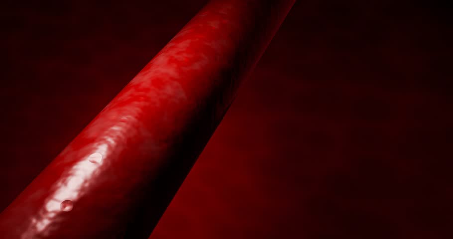 Artery narrowing due to cholesterol deposits, fast food intake, high-sugar beverages, alcohol addiction, processed foods, emphasizing risks hypertension, stroke, cardiovascular death. 3D rendering