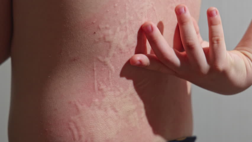 Kid with an aggressive form of hives, nettle rash on back. Child with inflamed ear on white background scratching skin. Red, itchy welts common in children's allergic skin reactions.