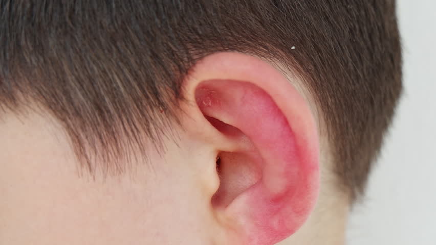 Kid with an aggressive form of hives, nettle rash on back. Child with inflamed ear on white background scratching skin. Red, itchy welts common in children's allergic skin reactions.