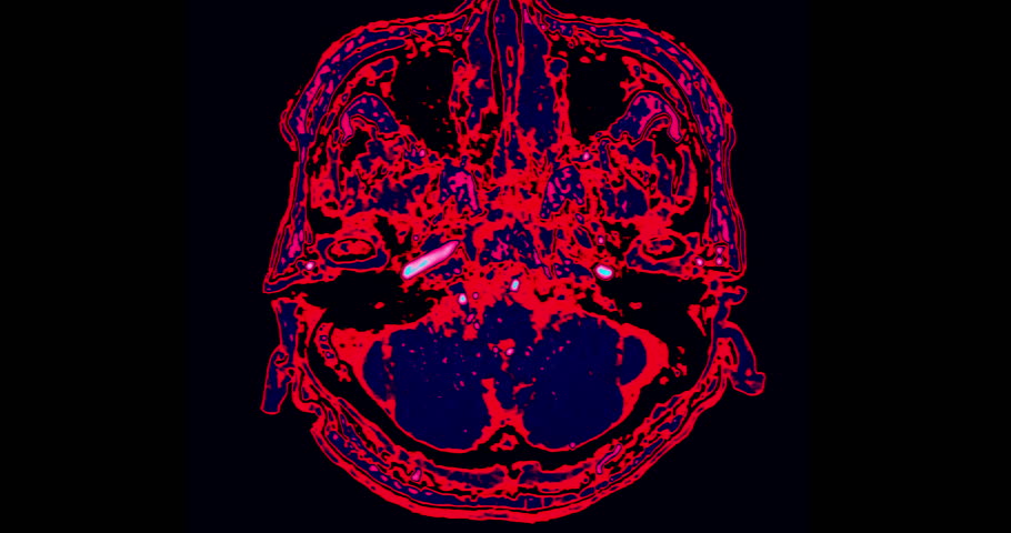 MRI brain scan with color highlights  offering detailed insights into blood flow and brain function. Essential for accurate diagnosis and treatment planning.