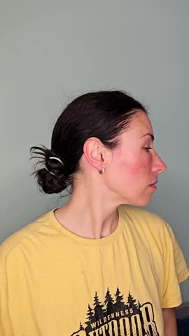 bee sting in the eye, swollen cheek, quincke's edema, allergic reaction to insect bite, black eye, angioedema,