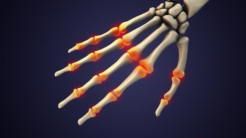 Inflamed Joints and Swelling from Rheumatoid Arthritis