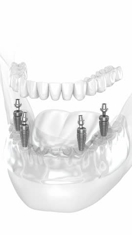 Dental prosthesis supported by four implants. Dental 3D animation