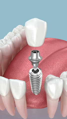 Dental implant and ceramic crown. Medically accurate tooth 3D Animation