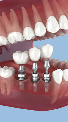 Tooth crowns placement over 3 implants. Dental 3D Animation