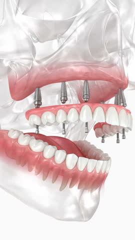 Dental prosthesis based on six implants. Dental 3D animation 
