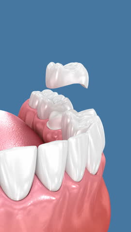Preparated molar tooth and dental crown placement. Dental 3D animation