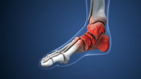 Degenerative Arthritis Impacting the Ankle Area - Powered by Shutterstock - Get 15% off with code: PIKWIZARD15