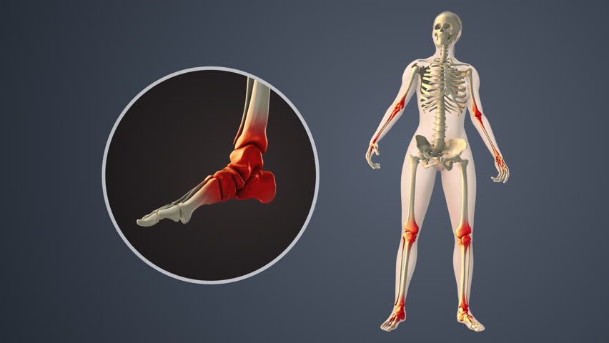 Degenerative Arthritis Affecting Inner Ankle Joint Spaces