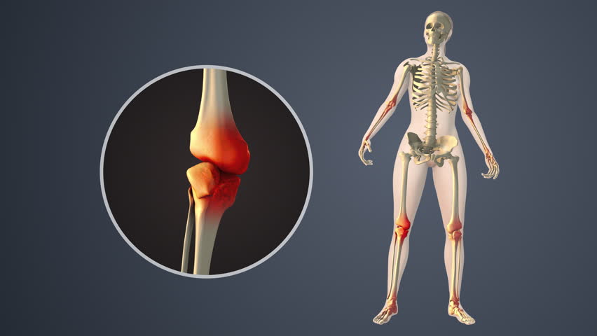 Degenerative Arthritis Affecting Inner knee Joint Spaces